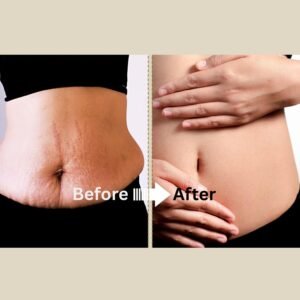 loose skin after pregnancy